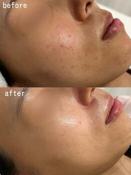 スパ ナナプラス(SPA nana+)/艶肌☆剥離なしピーリング