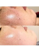 アンジェーム(ANGEAME)/ハーブトリートメント