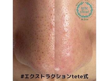 プラスエム(+M)/毛穴美人