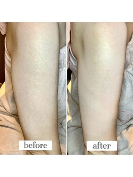 ジグリー(JIGGLY)/ヒジ上シュガーリング