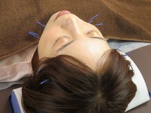 モグ(MOGU)/美容鍼でお肌の活性化