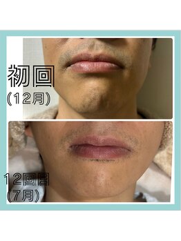 ルーチェ/【ヒゲ脱毛】ビフォーアフター