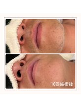 エアリアル 博多店/メンズ　ヒゲ脱毛before→after
