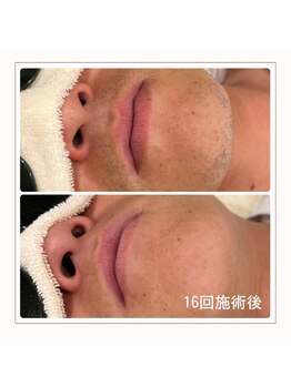 エアリアル 博多店/メンズ　ヒゲ脱毛before→after