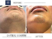 メンズメイド(Mens'Made)/before /after