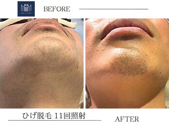 メンズメイド(Mens'Made)/before /after