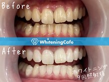 ホワイトニングカフェ 原宿店/ホワイトニングビフォーアフター