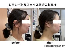 トータルビューティーみつとも/レモンボトル/顔のたるみ/二重顎