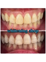 ホワイトニングショップ 三田店/before after