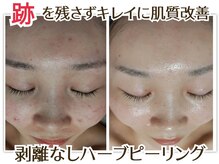 サロン ド ヒノキ(Salon de HINOKI)の雰囲気（剥離なしで磨き上げるハーブピーリング☆透明感を即実感！）