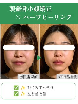 ブプラ 代々木上原店(BUPURA)/小顔×透明感UP