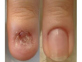 リファーレ(RIFARE)/【深爪矯正】健康的なお爪に!