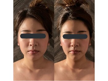 ハイコガオ 中崎町店(HIKOGAO)/小顔矯正