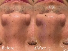 シャルム(Charme)/メンズフェイシャル♪毛穴ケア