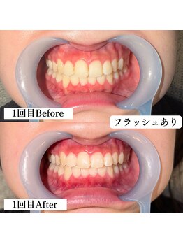 ラペカ(Lapeca)/セルフホワイトニング名古屋