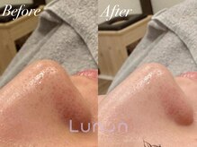 ルノン(Lunon)/毛穴洗浄ハイドロ