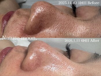 ナチュールムーン(Nature moon.)/毛穴洗浄