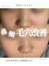 エイル(EILE)/症例3