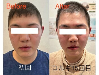 ビーキュート 姫路店(BE-CUTE)/コルギ15回目