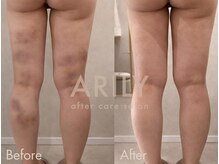 アリリィ(ARILY)/ダウンタイムケア/表参道/外苑前