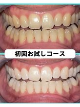 ホワイトニングビューティー 吉祥寺店/ホワイトニング　初来店
