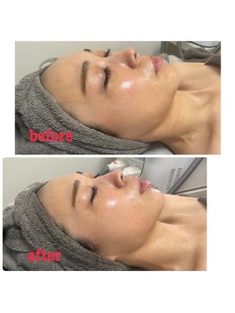 ダリア(Dahlia)/ハーブピーリング