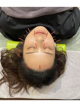 守谷やまゆり鍼灸整骨院/美容鍼始めました♪