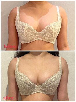 リール 新宿店(RIRE)/50代後半 バストアップ症例