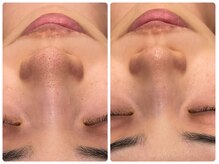 エステティック レイビス 青森店(RAYVIS)/小鼻の毛穴汚れ改善に自信あり！