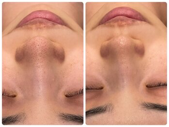 エステティック レイビス 青森店(RAYVIS)/小鼻の毛穴汚れ改善に自信あり!