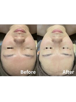 エクラ(ECLAT)/レストトリートメント