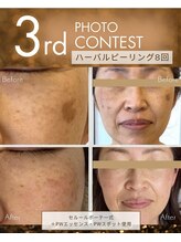 エクセレントビューティーサロン 艶(EN)/シミケアにハーバルピーリング