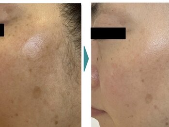 パルファンカルム 駅西本町店/目指せ!白玉水光肌!