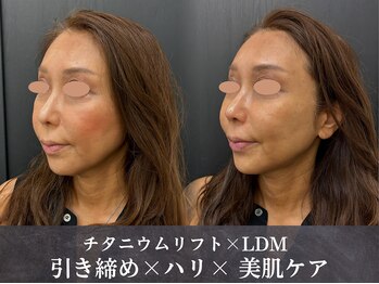 イロハ(IROHA)の写真/兵庫県初導入◆真皮層へアプローチ*高密度エネルギー[チタニウムリフト]で引締め×ハリ×美肌ケアを一度に