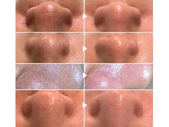 サロンドラヴィン(salon de Lovin)の写真/【枚方で肌改善するならココ!】黒ずみ毛穴・慢性ニキビも繰り返す肌悩みから卒業！