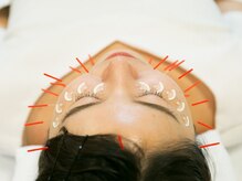 もり鍼灸整骨院 今出川マッサージ治療院/美容鍼/小顔矯正