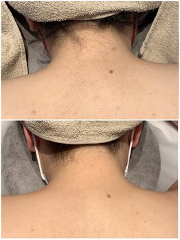 ディオーネ 春日井勝川店(Dione)/うなじ脱毛ビフォーアフター