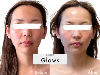 グロウズ(Glows)/当院独自の小顔施術