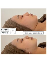 サロン ド パーフェクション(Salon de Perfection)/小顔リフト