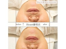 ハート 藤枝店(Heart)の雰囲気（大人気のフォト光フェイシャルでしわ改善・たるみケア！）