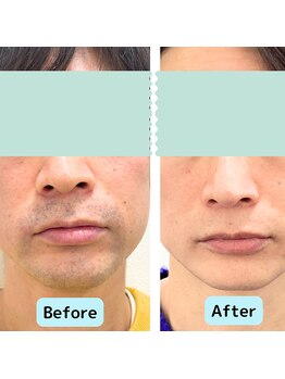 リオンズ 千葉アリオ柏店/若々しい印象に【ヒゲ脱毛】