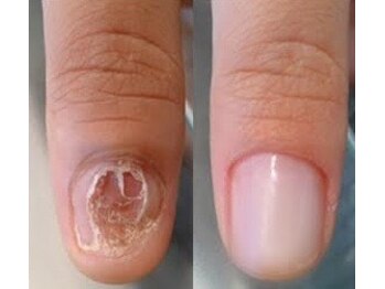 リファーレ(RIFARE)/【深爪矯正】爪が無いから大変化