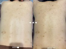 フルール(Fleur)/■背中トリートメント■