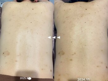 フルール(Fleur)/■背中トリートメント■