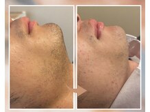 プルベル 平尾(Plus Belle)/ヒゲ脱毛