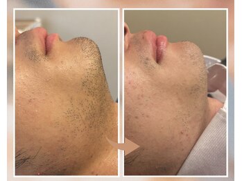 プルベル 平尾(Plus Belle)/ヒゲ脱毛