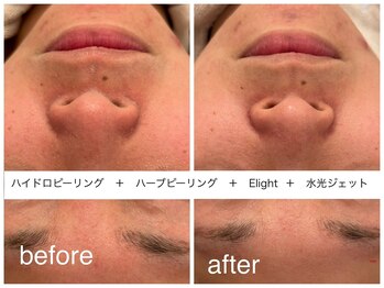 メゾンリュバン 梅田店(Maison Ruban)/毛穴洗浄・ハーブピーリング