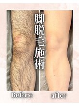 フィズ 海老名店(FIS)/脚脱毛