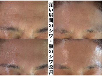 ルミア(LUMIA)/深い眉間のシワ・額のシワ改善