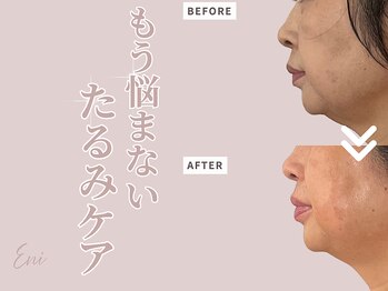 エニ(Eni)/輪郭すっきり！横顔美人へ